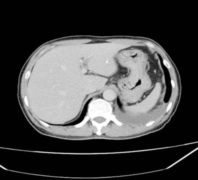 CT Scan chest Stock Photos