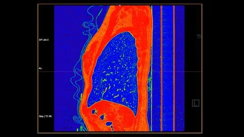 CT scan of Chest sagittal view in color mode  for diagnostic Pulmonary embo.. Stock Illustration