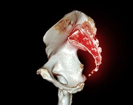 CT scan of coccyx  3D rendering for diagnosis fracture of Pelvic bone and hip Stock Illustration