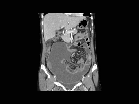 CT Scan ( Computed tomography ) of whole abdomen with contrast. Coronal and Sagi Stock Footage 158902059