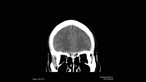 CT scan coronal view with bullet fragmentation in brain male 20 year old Stock Footage 132925370