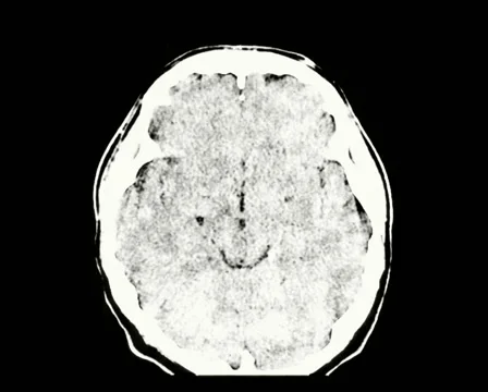 Ct scan down through brain and eyes Stock Footage 935595