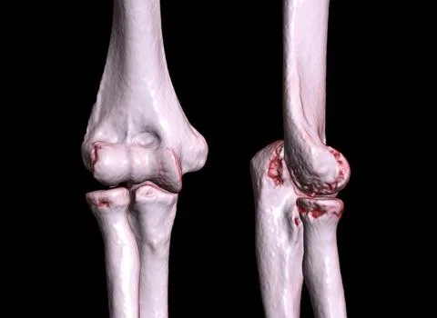 CT scan of elbow joint 3d rendering. Stock Illustration