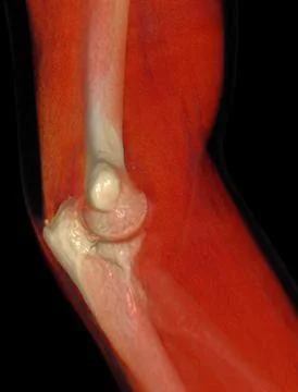 CT scan of elbow joint 3d rendering . Stock-Illustration