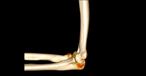 CT scan of elbow joint 3d rendering . Stock Illustration