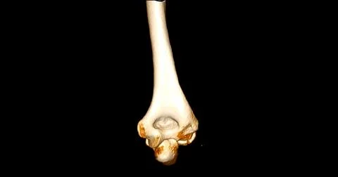 CT scan of elbow joint 3d rendering  showing humerus bone. Stock Illustration