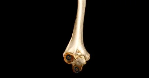 CT scan of elbow joint 3d rendering  showing humerus bone. Stock Illustration
