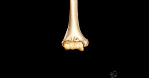 CT scan of elbow joint 3d rendering  showing humerus bone. Stock Illustration