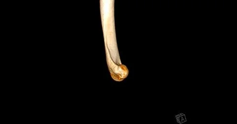 CT scan of elbow joint 3d rendering  showing humerus bone. Stock-Illustration
