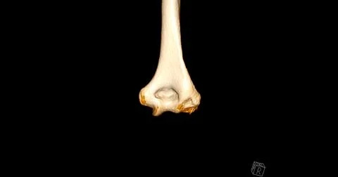 CT scan of elbow joint 3d rendering  showing humerus bone. Stock-Illustration