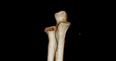 CT scan of elbow joint 3d rendering  showing ulna and radius bone. Stock Illustration