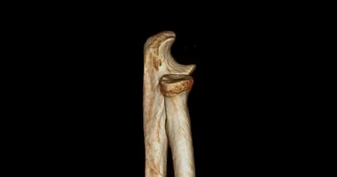CT scan of elbow joint 3d rendering  showing ulna and radius bone. Stock Illustration