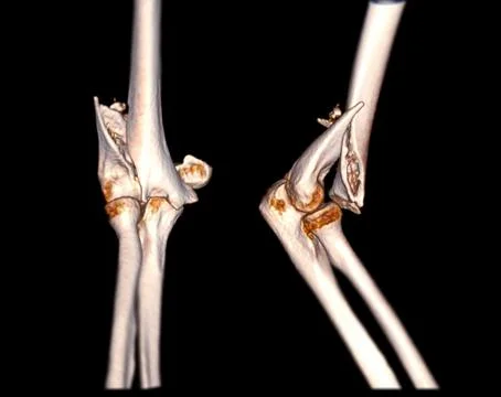 CT scan of elbow joint Stock-Illustration