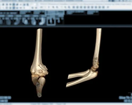 CT scan of elbow joint Stock Illustration