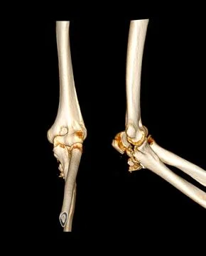 CT scan of elbow joint Illustrazione stock