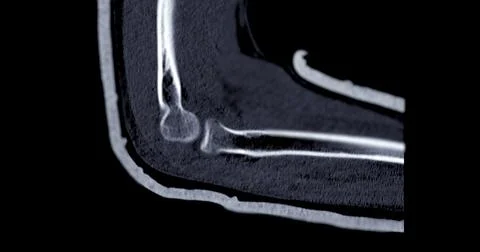 CT scan of elbow joint sagittal view. Stock Illustration