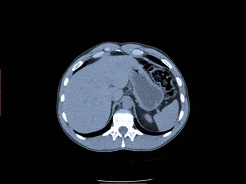 CT Scan Stock Footage 43258938