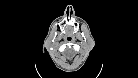 CT scan Video stock 94383140