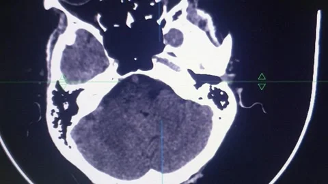 CT Scan Stock Footage 313143038