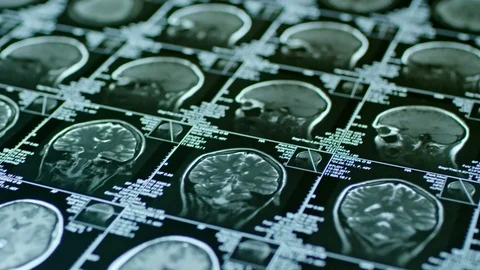 CT Scan of Human Brain Stock Footage 80985397