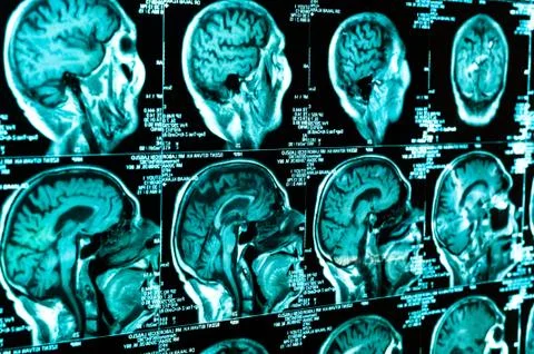 Ct scan of the human brain tile Stock Photos