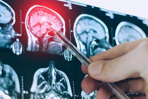 CT scan image of human brain. Mri or x-ray scan for diagnostic human head d.. Foto stock