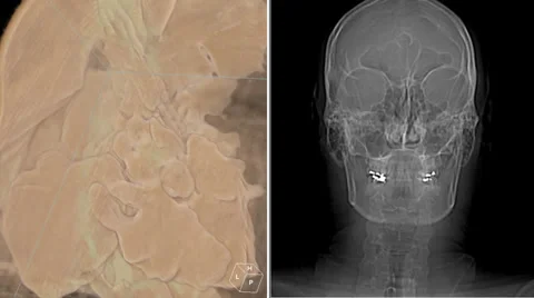CT Scan Image: Split screen review of sinuses 3D rendering Video stock 37216654