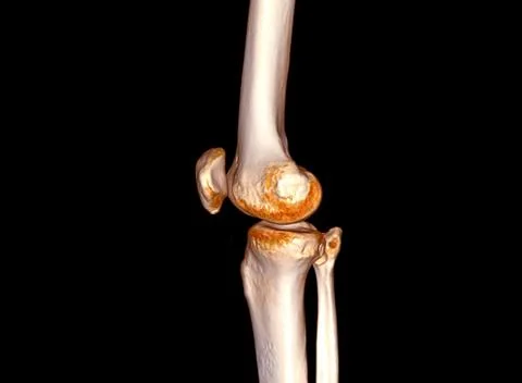 CT Scan of  Knee joint 3D rendering . Stock Illustration
