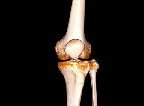 CT Scan of  Knee joint 3D rendering . Illustrazione stock