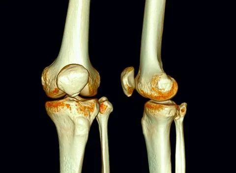 CT Scan of  Knee joint 3D rendering . Stock Illustration