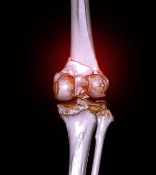 CT scan of knee joint 3D rendering image  showing fracture of distal femur .. Stock Illustration