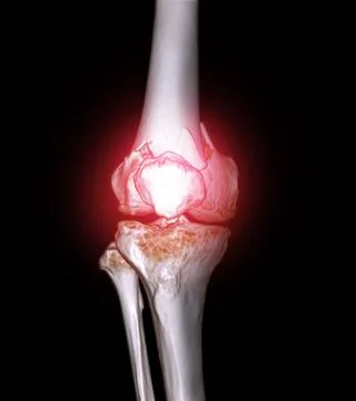 CT scan of knee joint 3D rendering image  showing fracture of distal femur .. Illustrazione stock