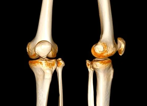CT Scan of  Knee joint 3D rendering Showing fracture of Patella . Illustrazione stock