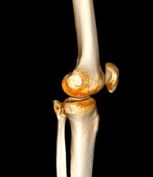 CT Scan of  Knee joint 3D rendering Showing fracture of Patella . Illustrazione stock
