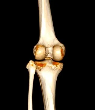 CT Scan of  Knee joint 3D rendering Showing fracture of Patella . Stock Illustration