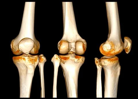 CT Scan of  Knee joint 3D rendering Showing fracture of Patella . Stock Illustration