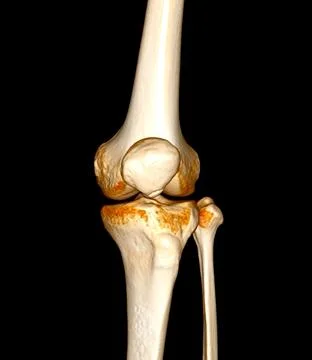 CT Scan of  Knee joint 3D rendering Showing fracture of Patella . Stock Illustration