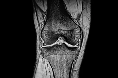 CT Scan Knee joint Stock Photos