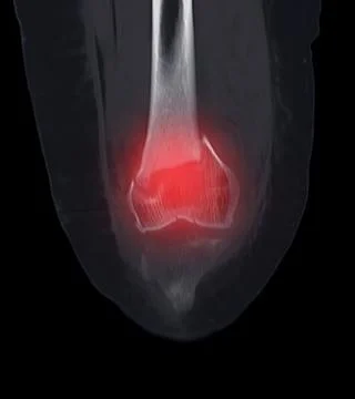 CT scan of knee joint   showing fracture of distal femur bone. Illustrazione stock
