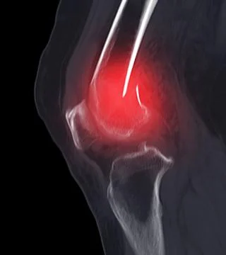 CT scan of knee joint   showing fracture of distal femur bone. Stock Illustration