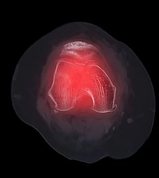 CT scan of knee joint   showing fracture of distal femur bone. Stock Illustration
