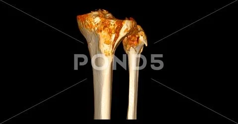 CT Scan of Knee joint showing fracture tibia and fibula bone 3D ...