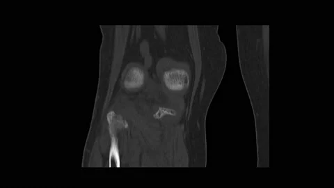 CT Scan knee of the patient periarticular injuries fracture of the proximal t Stock Footage 158902102