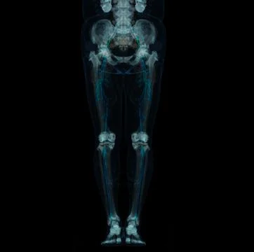 CT scan of lower extremity  ,3D illustration of Femur bone , knee joint , leg Stock Illustration