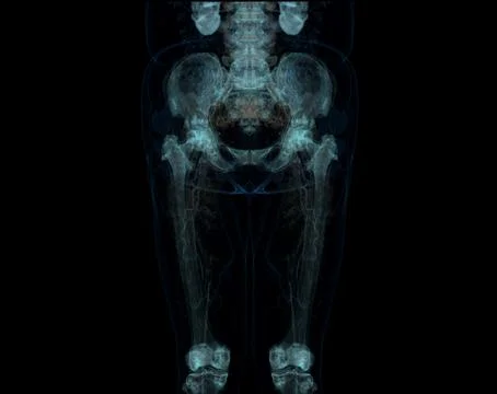 CT scan of lower extremity  ,3D illustration of Femur bone , knee joint , leg Stock Illustration