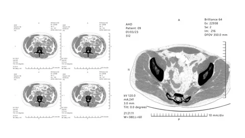 CT scan. MRI x ray Scan.Medical HUD Analyzing abdominal liver diagnosis.White Stock Footage 264500192