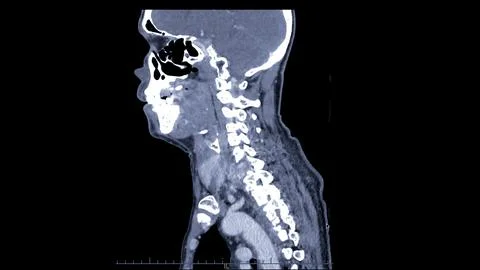 A CT scan of the neck sagittal view for diagnostic technique is essential f.. Stock Illustration