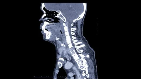 A CT scan of the neck sagittal view for diagnostic technique is essential f.. Stock Illustration