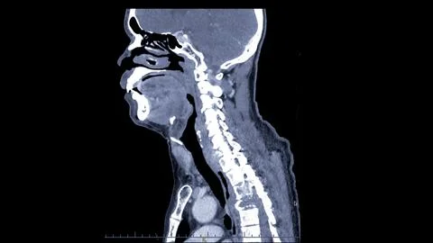 A CT scan of the neck sagittal view for diagnostic technique is essential f.. Stock Illustration