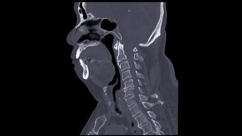 A CT scan of the neck sagittal view for diagnostic technique is essential f.. Stock Illustration